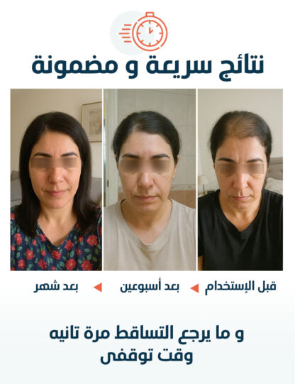 علاج تساقط الشعر العرضي و الحمايه من التساقط الموسمي - Image 4